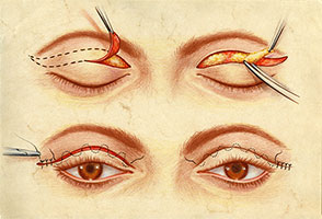 blepharoplasty-abroad